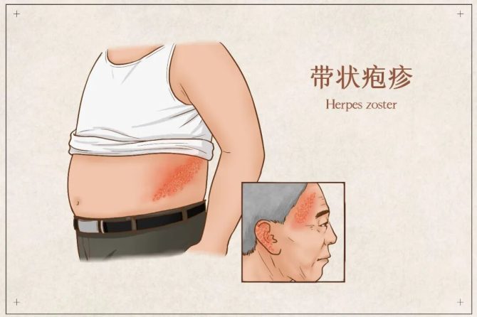 别让“缠腰龙”缠住晚年幸福：关于带状疱疹，筑牢健康防线