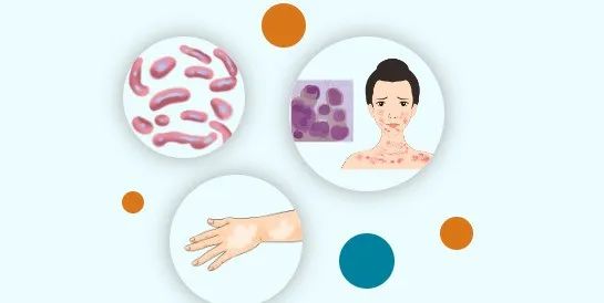 【世界防治麻风病日】可防可治不可怕！麻风病防治小知识