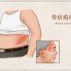 别让“缠腰龙”缠住晚年幸福:关于带状疱疹,筑牢健康防线