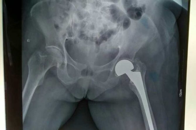 八旬老人在我院成功接收陈旧性股骨颈骨折人工髋关节置换术
