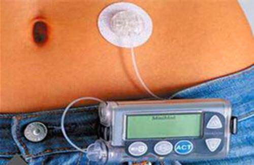 血糖管理的终极武器“胰岛素泵”