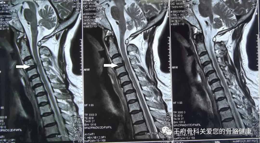 危险！被忽略的颈椎病