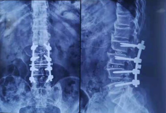 医者仁心，生命至上！王府医院成功为一位高风险腰椎管狭窄患者实施手术