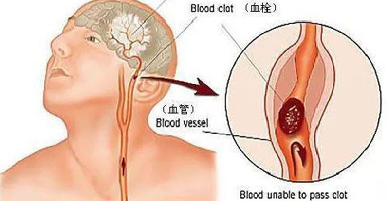 注意！警惕脑血栓前的这些征兆，避免意外发生