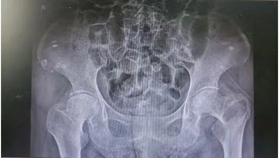 多学科联合成功救治高龄股骨颈骨折合并重度肺部感染、双下肢深静脉血栓病人