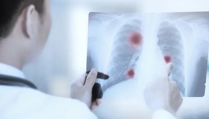 全球肺癌关注月 | 预防肺癌有方法