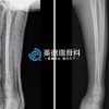 北京王府医院美德瑞骨科中心成功完成首例儿童桡骨干骨折内固定术