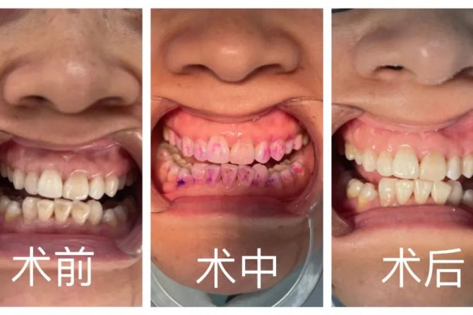 我院口腔科开展PMTC清洁术，为您的口腔健康保驾护航
